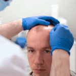 Hair Transplant Options Explained for Safe and Easy Results