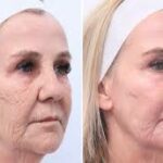 How Should I Prepare for a Laser Resurfacing Procedure?
