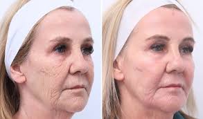 How Should I Prepare for a Laser Resurfacing Procedure?