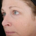 Dark Spots Correction in Chevy Chase – Everything You Need to Know