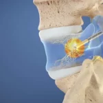 Relief Through Minimally Invasive Pain Care