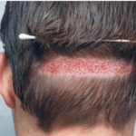 Hair Transplant in Pakistan for Men and Women: What’s Different?