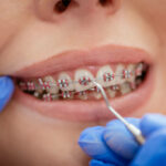A Smile Revival: Exploring Braces San Juan Capistrano Options