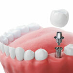 Tooth Implant Cost in Dubai: Factors That Influence Pricing
