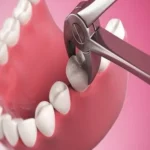 What Affects Teeth Removal Cost in Dubai Dental Centers