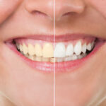 Brightening Smiles Naturally with Teeth Whitening Park Ridge Methods