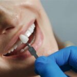 Understanding Porcelain Veneers Cost in Sydney: What You Need to Know