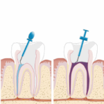 Wurzelkanal Zürich – Präzise Endodontie bei den Zahnärzten Zürich Gartenstrasse