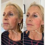 Endolift Treatments in Dubai for Double Chin Reduction and Neck Contouring