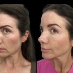 Under-Eye Fillers for Dark Circles Treatment at the Best Aesthetic Clinics in Dubai
