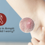 Why Is There a Lump in My Armpit? When Should I Worry About a Lump in My Armpit?