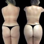 Best Aesthetic Clinic in dubai for Safe Hyacorp Fillers