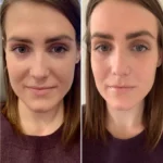 Best Plastic Surgeon in Dubai PRP Treatment for Collagen Boost
