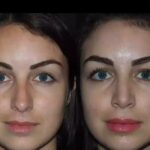 Best Septoplasty Surgeons in Dubai: Experts Who Help You Breathe Better