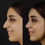 The Road to Easier Breathing: Best Septoplasty Surgeon in Dubai