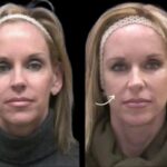 Risks of Sculptra in Dubai and How to Avoid Them