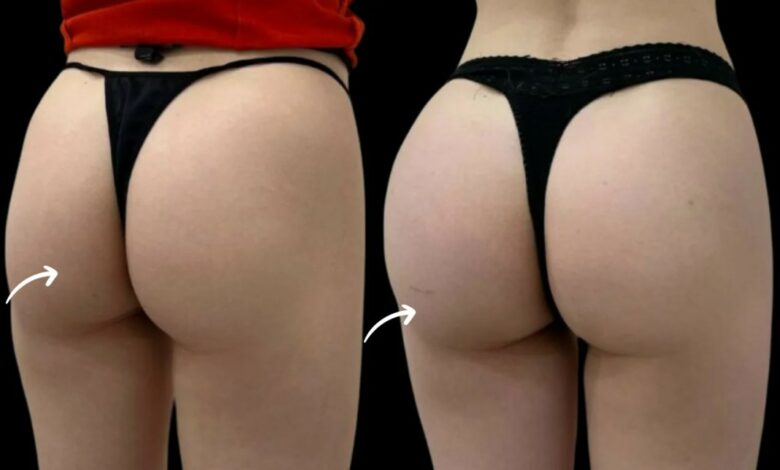 Sculptra Butt Lift by Best Doctors in Dubai