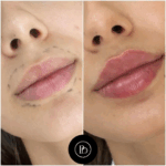 How Juvederm Can Transform Your Cheeks and Jawline at the Best Aesthetic Clinics in Dubai