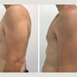 Gynecomastia Surgery in Dubai: Partner Support and Family Involvement
