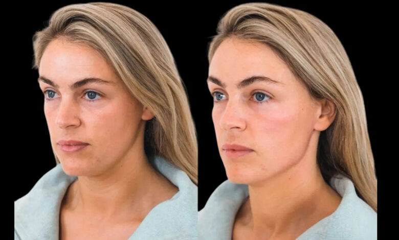 The Safety Protocols of Cheek Fillers in Dubai Clinics