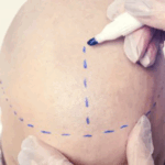 How the Best PRP Hair Treatment Delivers Fast Relief from Hair Loss