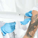Picosure Tattoo Removal Benefits You Need to Know for Smooth Skin