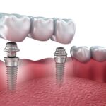 How Affordable Are Dental Services at Smile NYC?