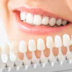 What Are Dental Veneers and How Do They Work?
