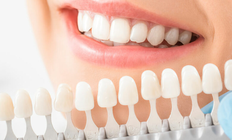 What Are Dental Veneers and How Do They Work?