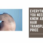 Everything You Need to Know About Hair Transplant Price