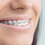 Smile Transformation Begins in Goshen: Braces in Focus for NY Residents