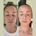 Skin Tightening and Lifting by the Best Plastic Surgeon in dubai with Fotona 4D Laser