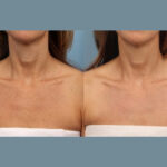 Confidence Restored by the Best Plastic Surgeon in dubai with Moxi Laser Treatment
