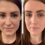 Best Doctors in Dubai PRP Treatment in Dubai for Skin Tightening
