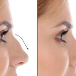 Septoplasty in Dubai: Restoring Function with Surgical Precision