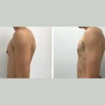 Best Gynecomastia Doctors in Dubai Helping You Get Rid of Man Boobs Permanently
