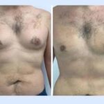 Understanding the Complete Surgical Procedure for Best Gynecomastia Surgeon in dubai