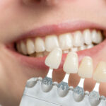 Get Natural Veneers in Islamabad | Painless Smile Transformation