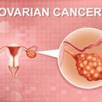 Is It IBS or Ovarian Cancer? How to Spot the Difference Early