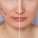 Say Goodbye to Acne Scars | Expert Skin Rejuvenation
