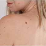 Understanding Skin Tag Removal Price | A Complete Guide for Patients