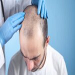 What Are the Psychological Benefits of Hair Transplant Surgery?