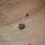 Tired of Warts? The Best Private Wart Removal Glasgow Clinics Offer