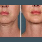 PRP Treatment in Dubai: A Comprehensive Guide to Hair Revival