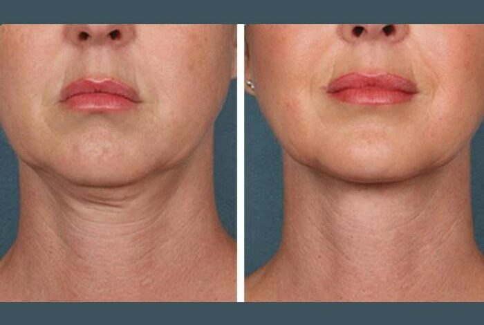 PRP Treatment in Dubai: A Comprehensive Guide to Hair Revival