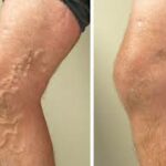 Top Qualities to Look for in a Clinic Offering Varicose Veins Treatment