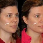 Sculptra Treatment in Dubai Tissue Response