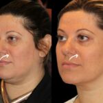Sculptra Eye Area Lift at Best Aesthetic Clinics in Dubai
