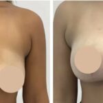 Enjoy Comfort Daily with the Best Breast Reduction Surgeons in dubai