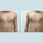 Gynecomastia Surgery in Dubai: Advanced Care, Natural Results